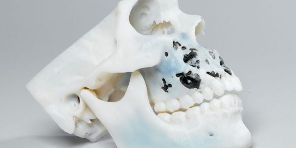hth华体会全站app由医疗设计师创造的3D打印头骨